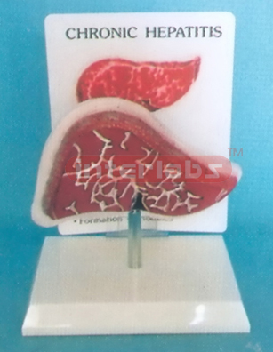 DESK-TYPE, CHRONIC HEPATITIS MODEL WITH DESCRIPTION PLATE